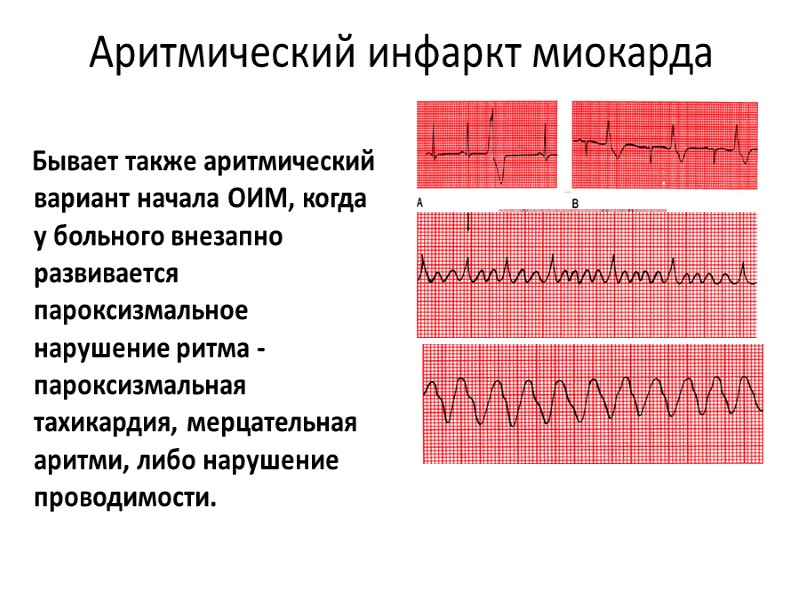 Аритмический инфаркт миокарда        Бывает также аритмический вариант
